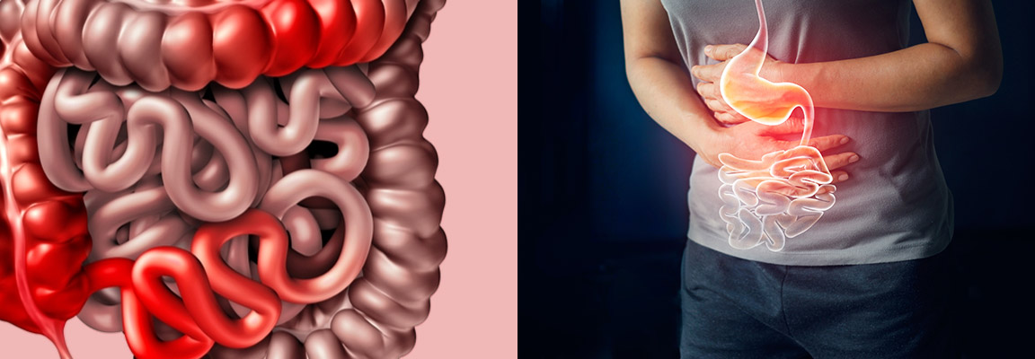 Crohn's disease and genetics