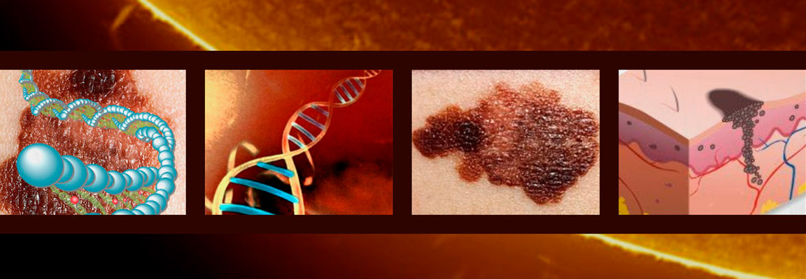 genetica del melanoma 