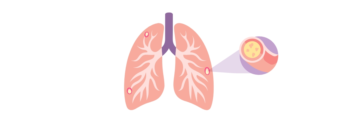 ¿La fibrosis quística es hereditaria?