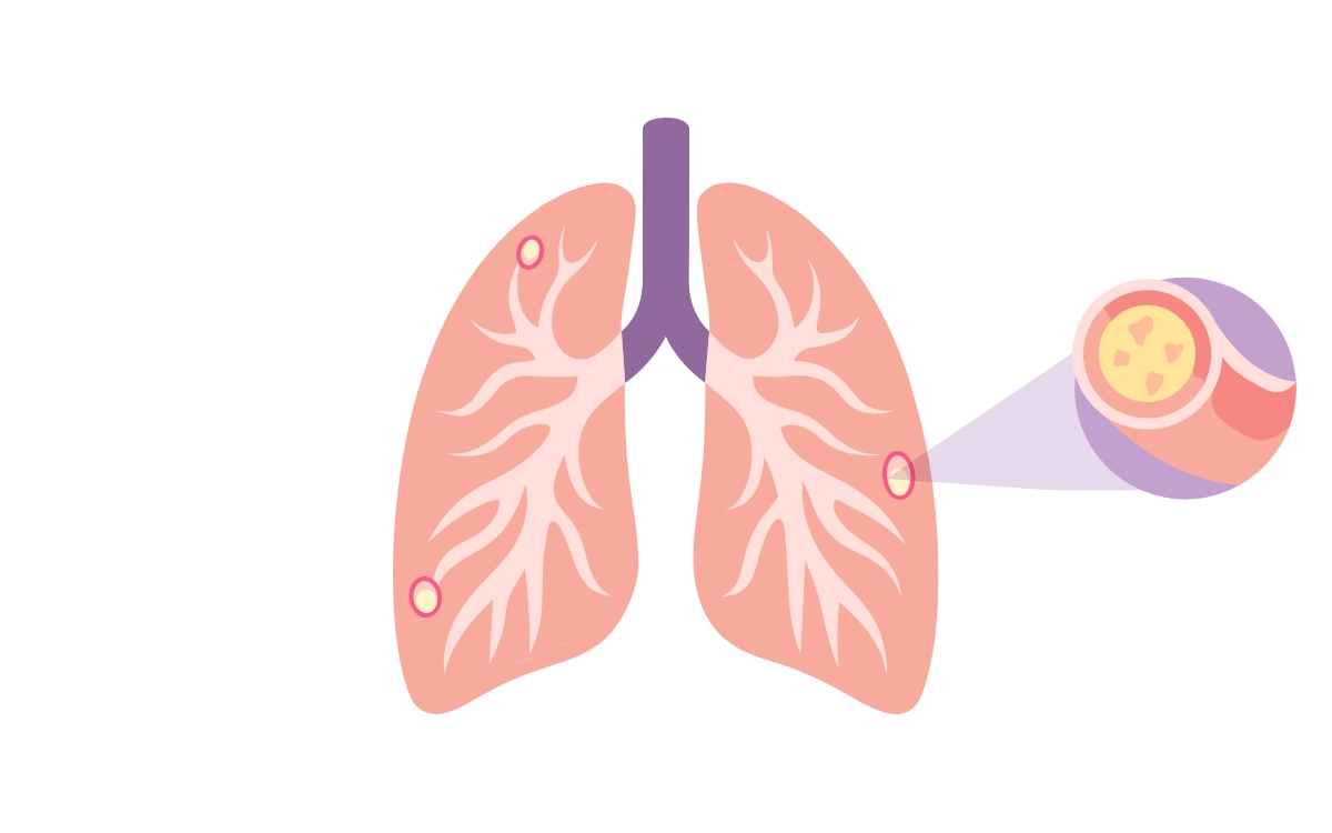 cystic fibrosis inheritance pattern